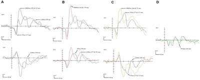 Atypical Frequency Sweep Processing in Chinese Children With Reading Difficulties: Evidence From Magnetoencephalography